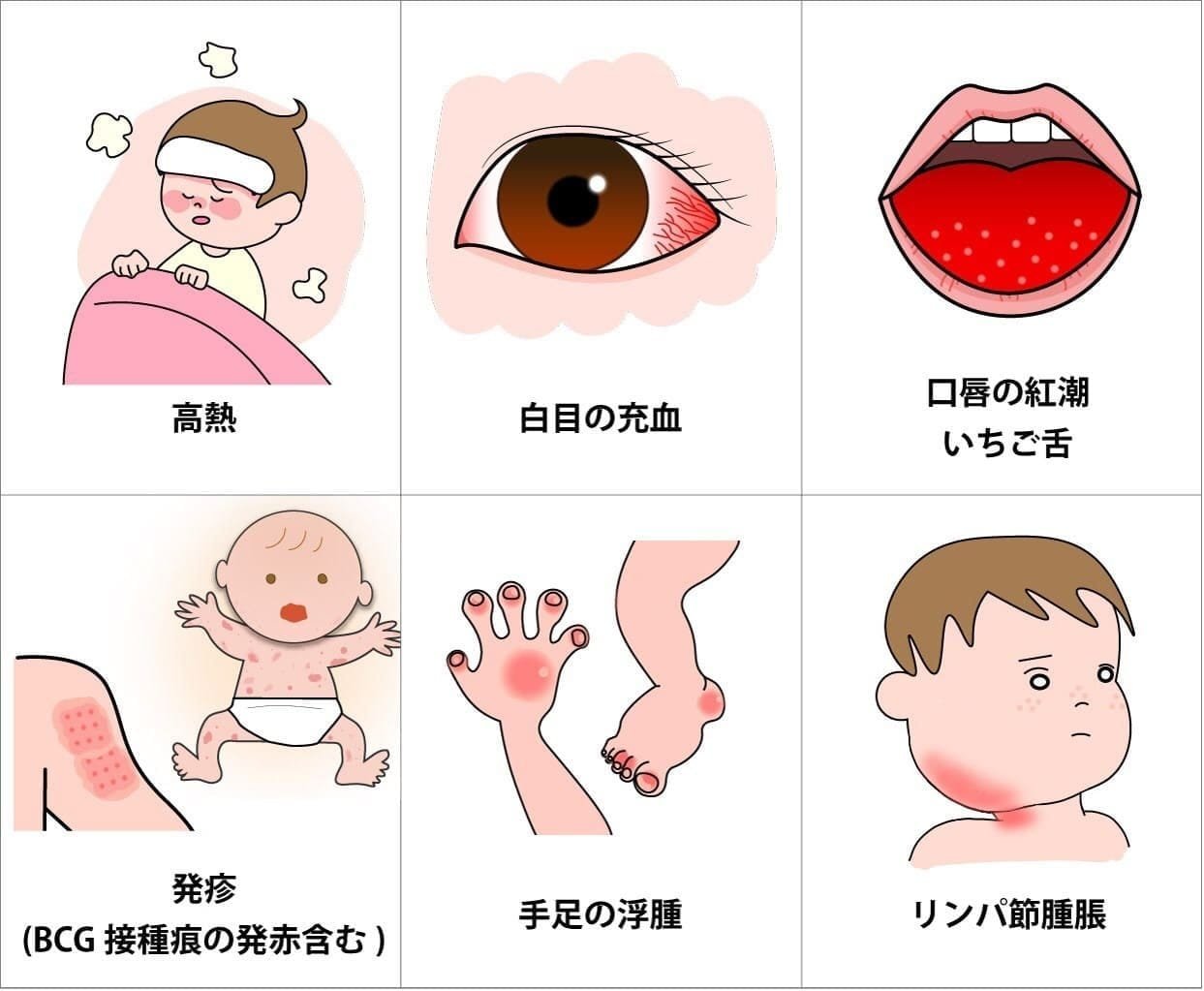 Kawasaki disease