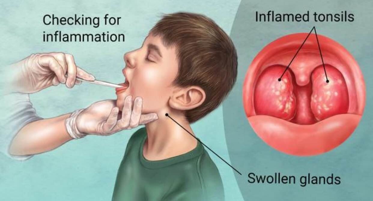 tonsillitis