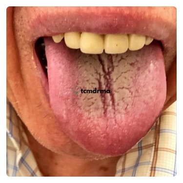 gout-tongue picture