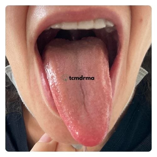 sciatica tongue